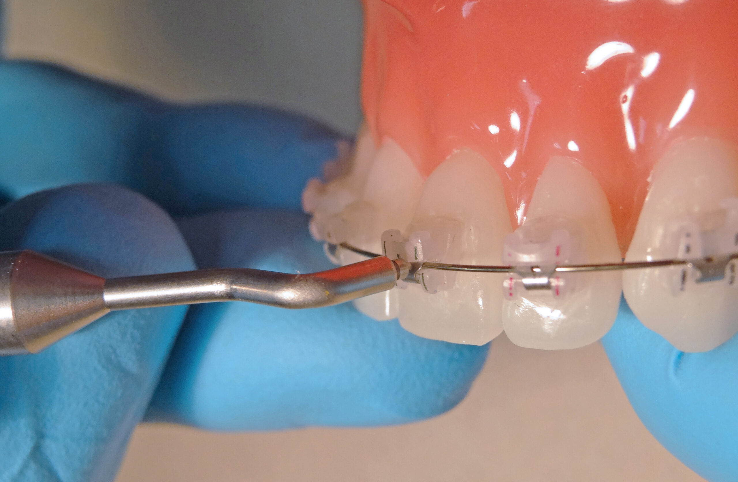 Collar probe typodont « Roncone Orthodontics International